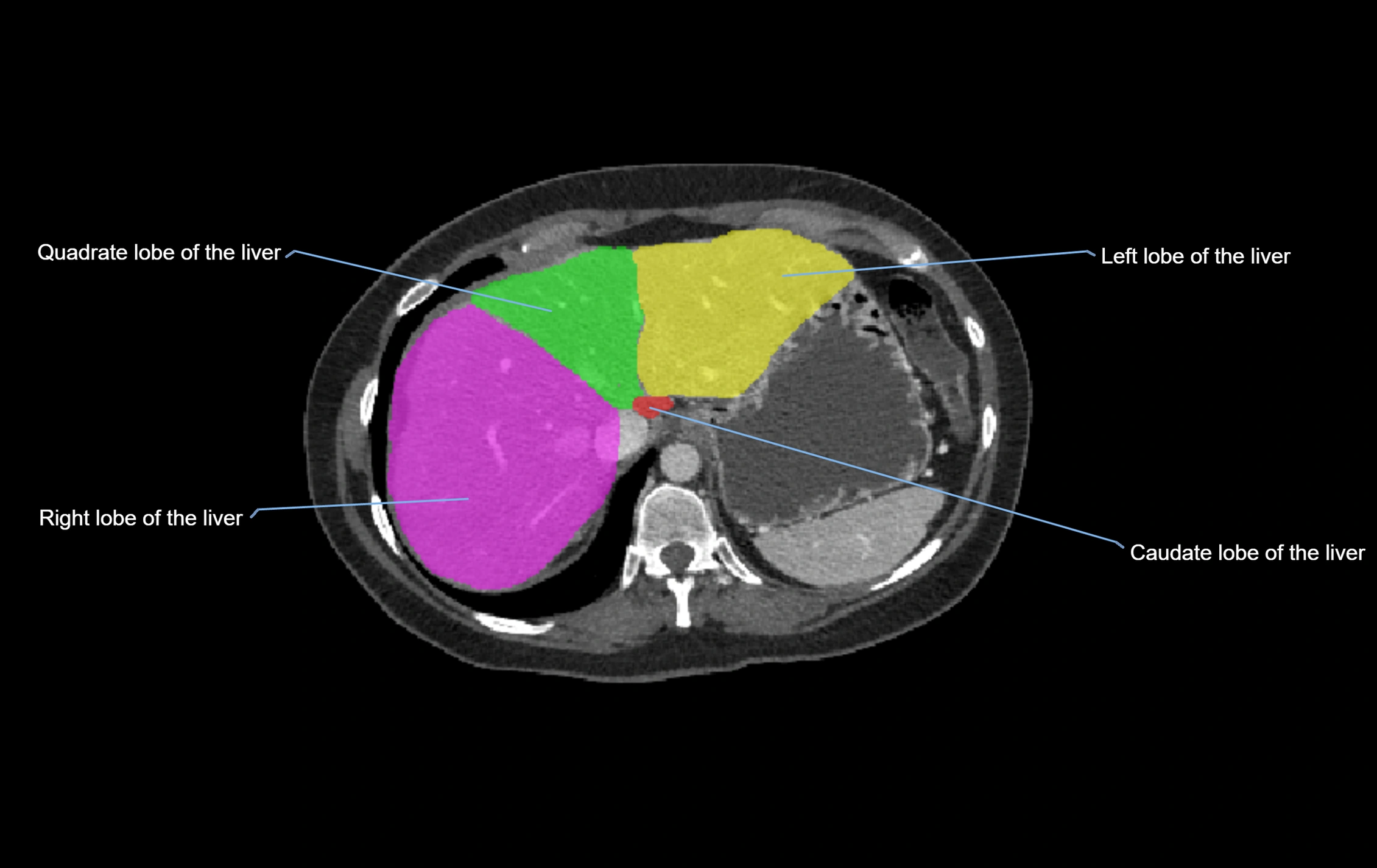 CT lliver lobes axial cross sectional anatomy labelled image -00060.webp